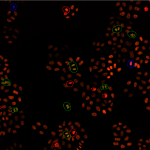 Organoid embedded in Matrigel. 
•20x objective
•50 slices a 2.5 um
•Nucleus DAPI
•Marker 1 Lysosomal
•Marker 2 red